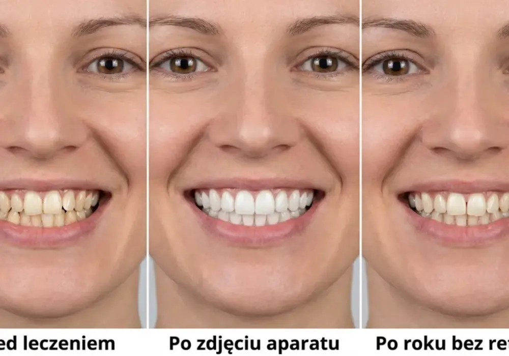 Aparat retencyjny - Jak utrzymać idealny uśmiech po leczeniu?
