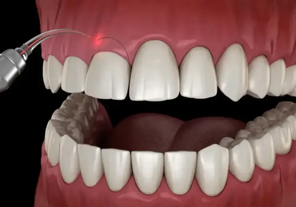Gingiwektomia - Kiedy usuwanie dziąsła ratuje uśmiech?