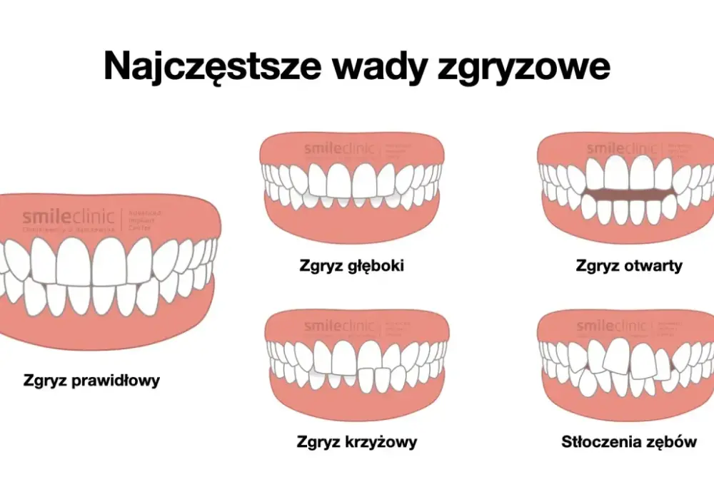 Prawidłowy zgryz - czy to tylko wygląd? Poznaj fakty i leczenie