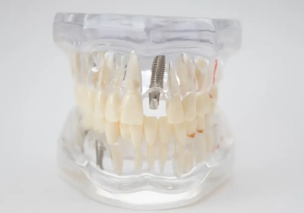Niepokojące objawy po wszczepieniu implantu zęba - kiedy reagować?