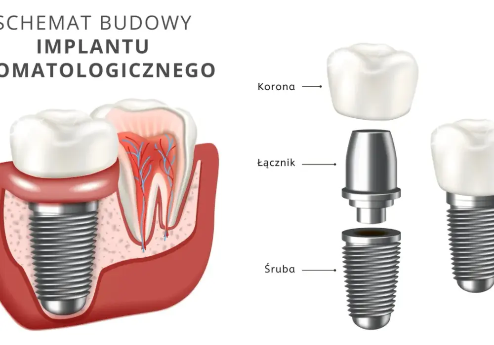 Implant zębowy krok po kroku. Zabieg, gojenie i koszt