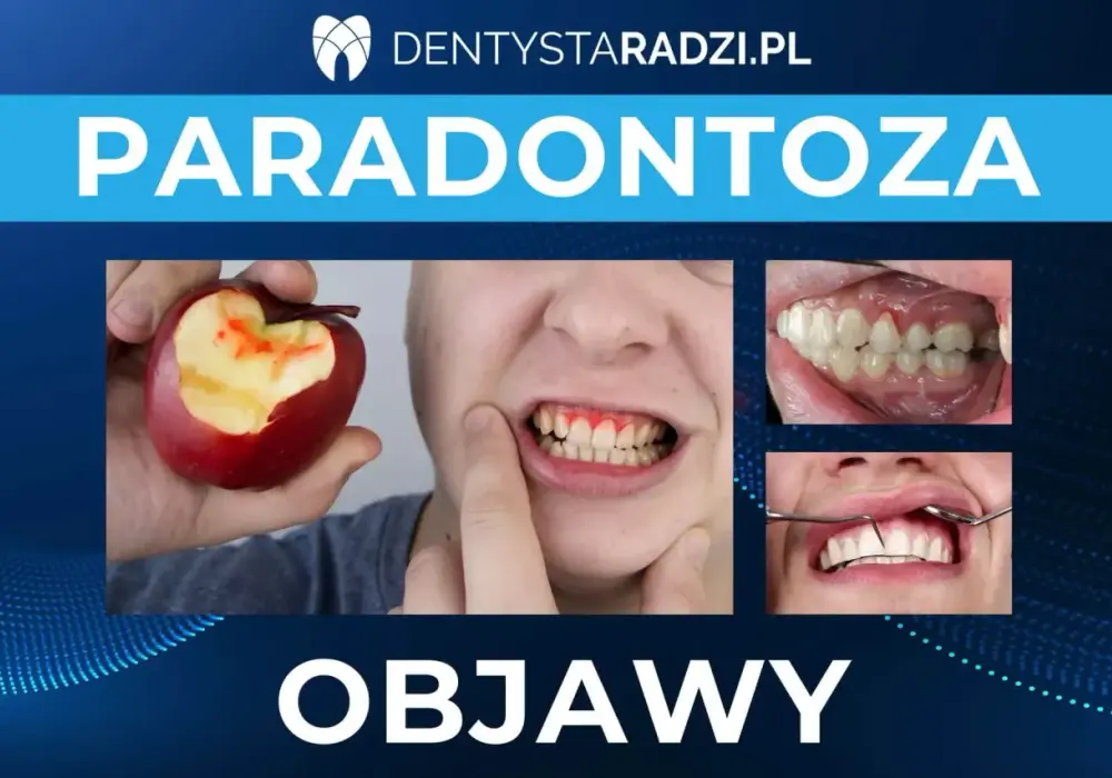 Paradontoza - Objawy, leczenie (NFZ) i trwałe efekty. Sprawdź!