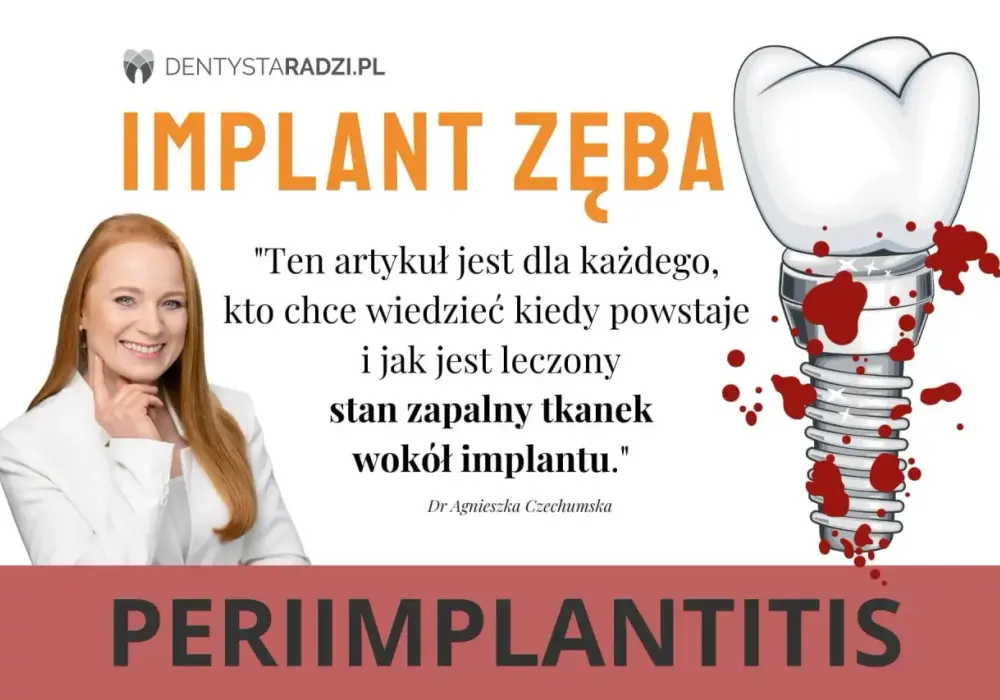 Ropień przy implancie - kiedy to periimplantitis?