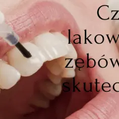 Co to jest lakowanie zębów i jak może uratować Twoje zęby?