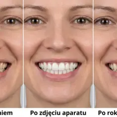 Uśmiech kobiety przed leczeniem, po zdjęciu aparatu i po roku bez retencji. Widać różnicę w prostowaniu zębów i utrzymaniu efektu.