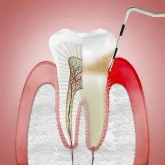 Przekrój zęba z widocznymi naczyniami krwionośnymi i nerwami. Narzędzie dentystyczne bada ząb otoczony przez zdrowe, różowe dziąsła, ale też przez zapalne, czerwone dziąsła.
