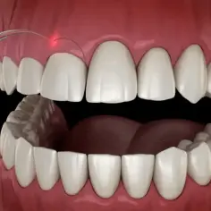Zabieg gingiwektomii laserem. Precyzyjne cięcie dziąseł w celu poprawy estetyki uśmiechu.