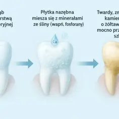 Proces powstawania kamienia na zębach: od czystego zęba, przez mineralizację płytki nazębnej, aż do żółtego, twardego kamienia.