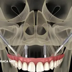 Model szczęki z implantami zygomatycznymi, pokazujący mocowanie protezy na implantach.
