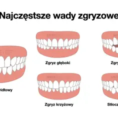 Zgryz prawidłowy to idealne ułożenie zębów. Obok wady zgryzowe: głęboki, otwarty, krzyżowy i stłoczenia.