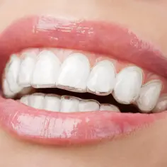 Uśmiech z dyskretnymi nakładkami Invisalign, które delikatnie korygują zęby, zapewniając piękny efekt.
