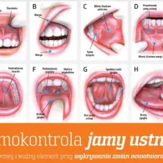 Jak wygląda rak jamy ustnej - objawy, które mogą zaniepokoić