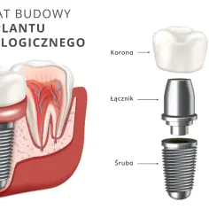 Schemat budowy implantu stomatologicznego: śruba, łącznik i korona. Widok przekroju zęba z implantem.