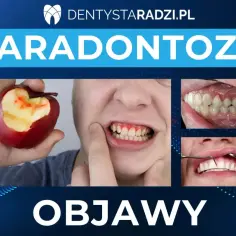 Objawy paradontozy: krwawiące dziąsła po ugryzieniu jabłka, odsłonięte szyjki zębów i cofające się dziąsła. Leczenie jest kluczowe.