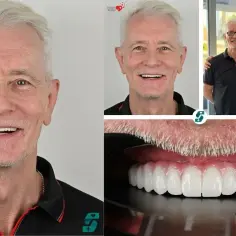 Uśmiechnięty mężczyzna przed i po zabiegu implantacji zębów. Nowe, białe zęby wyglądają naturalnie.