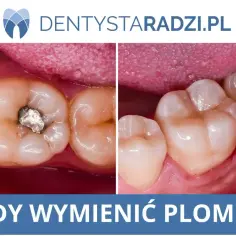 Porównanie zęba z amalgamatową plombą i zęba po wymianie plomby. Dwa obrazy pokazują stan zęba przed i po leczeniu.