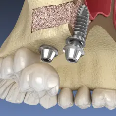 Model szczęki z implantami i materiałem kostnym. Widoczny podniesienie dna zatoki szczękowej, przygotowanie do wszczepienia implantu.