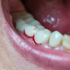 Krwawiące dziąsła, objaw zapalenia dziąseł (gingivitis), widoczne wokół zębów.