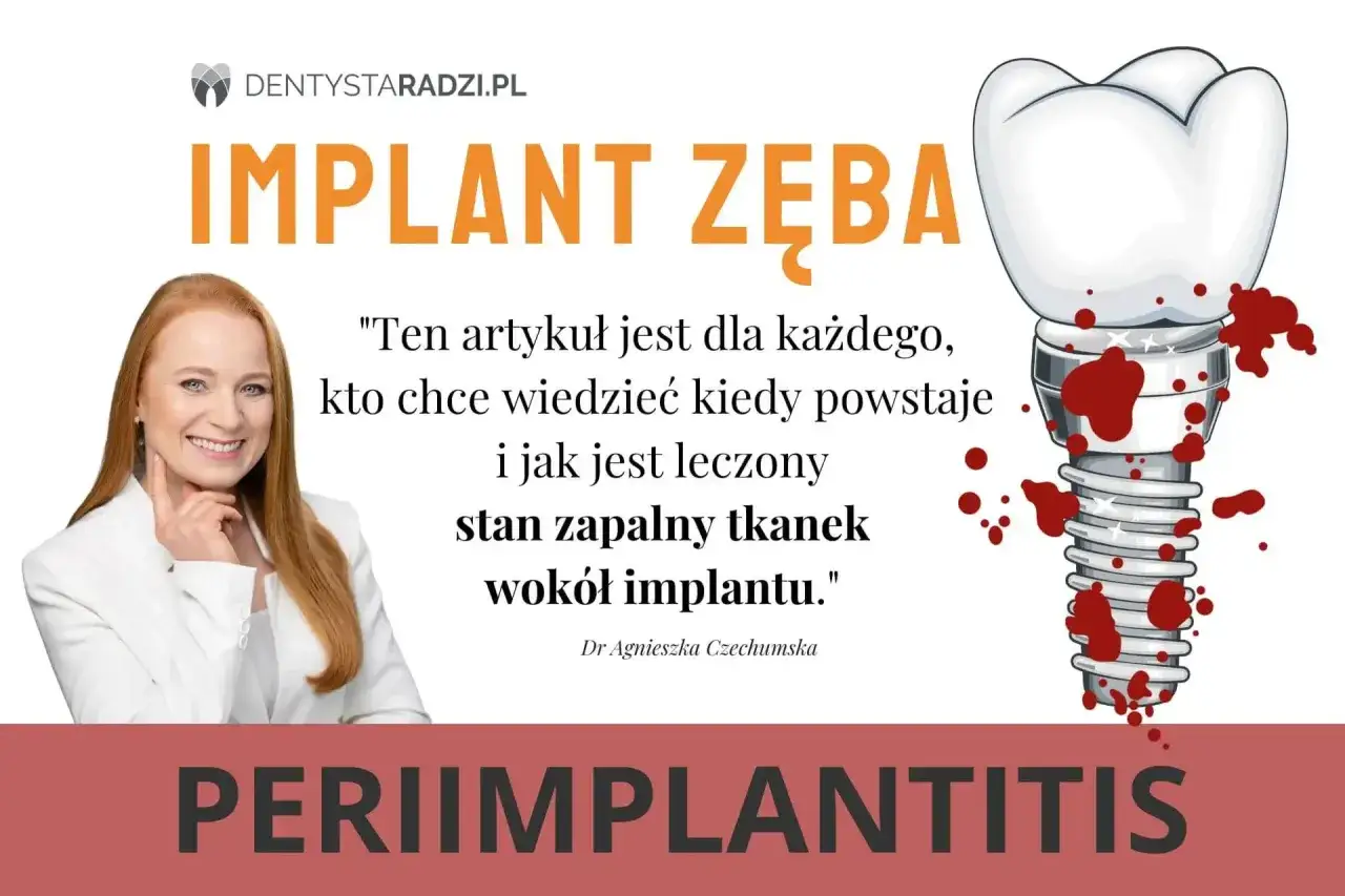 Stan zapalny tkanek wokół implantu, czyli periimplantitis, może prowadzić do ropnia. Grafika przedstawia implant zęba z krwawiącymi ranami.