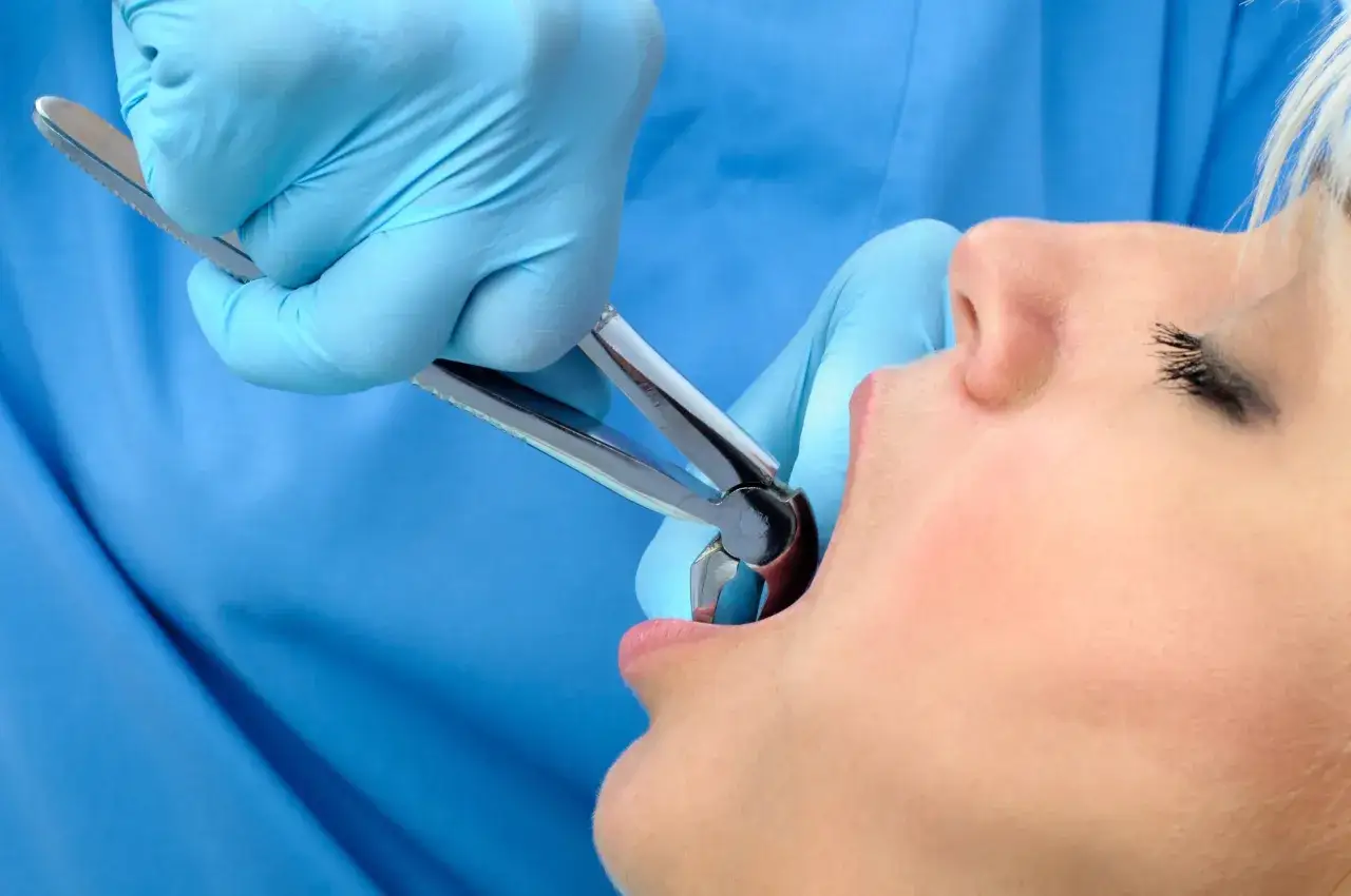 Dentysta w niebieskich rękawiczkach używa kleszczy do ekstrakcji zęba. Po zabiegu warto znać domowe sposoby na ból po wyrwaniu zęba.