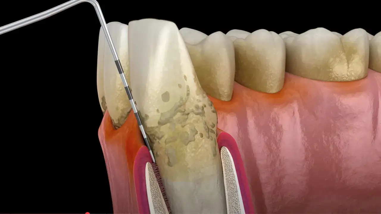 Zapalenie przyzębia: narzędzie dentystyczne usuwa kamień nazębny spod linii dziąseł, odsłaniając uszkodzoną tkankę.