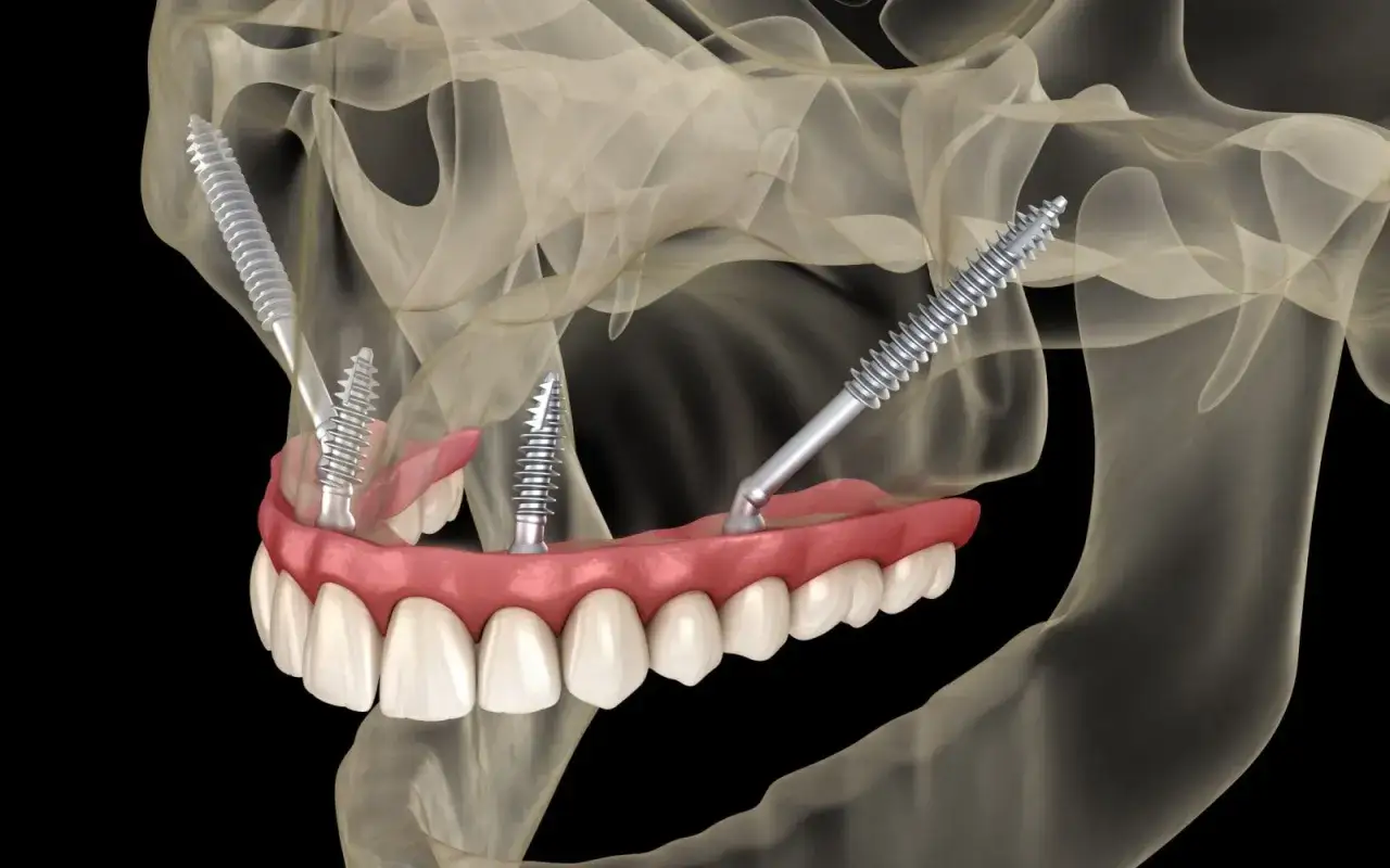 Model szczęki z implantami zygomatycznymi. Ilustracja pokazuje potencjalne powikłania po zabiegu implantacji.