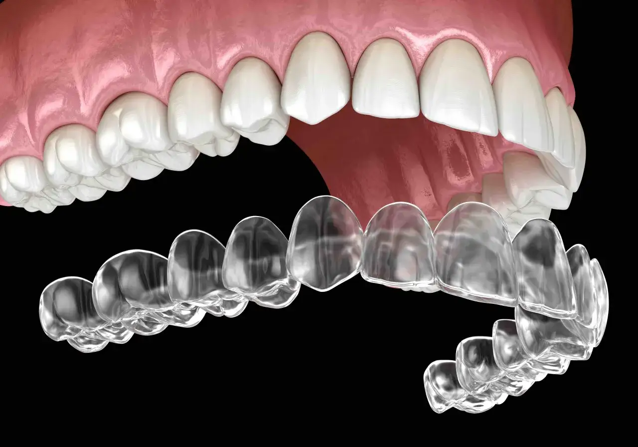 Przezroczyste nakładki na zęby, czyli aparat Invisalign, delikatnie korygują uśmiech.