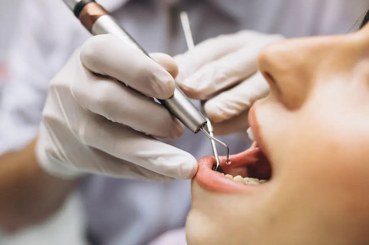 Dentysta w białej rękawiczce wykonuje zabieg leczenia paradontozy, używając specjalistycznego narzędzia w jamie ustnej pacjenta.