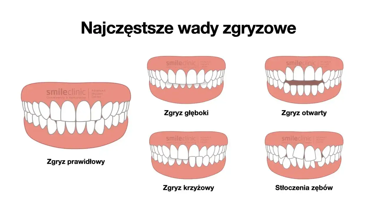 Zgryz prawidłowy to idealne ułożenie zębów, w przeciwieństwie do wad takich jak zgryz głęboki, otwarty, krzyżowy czy stłoczenia.