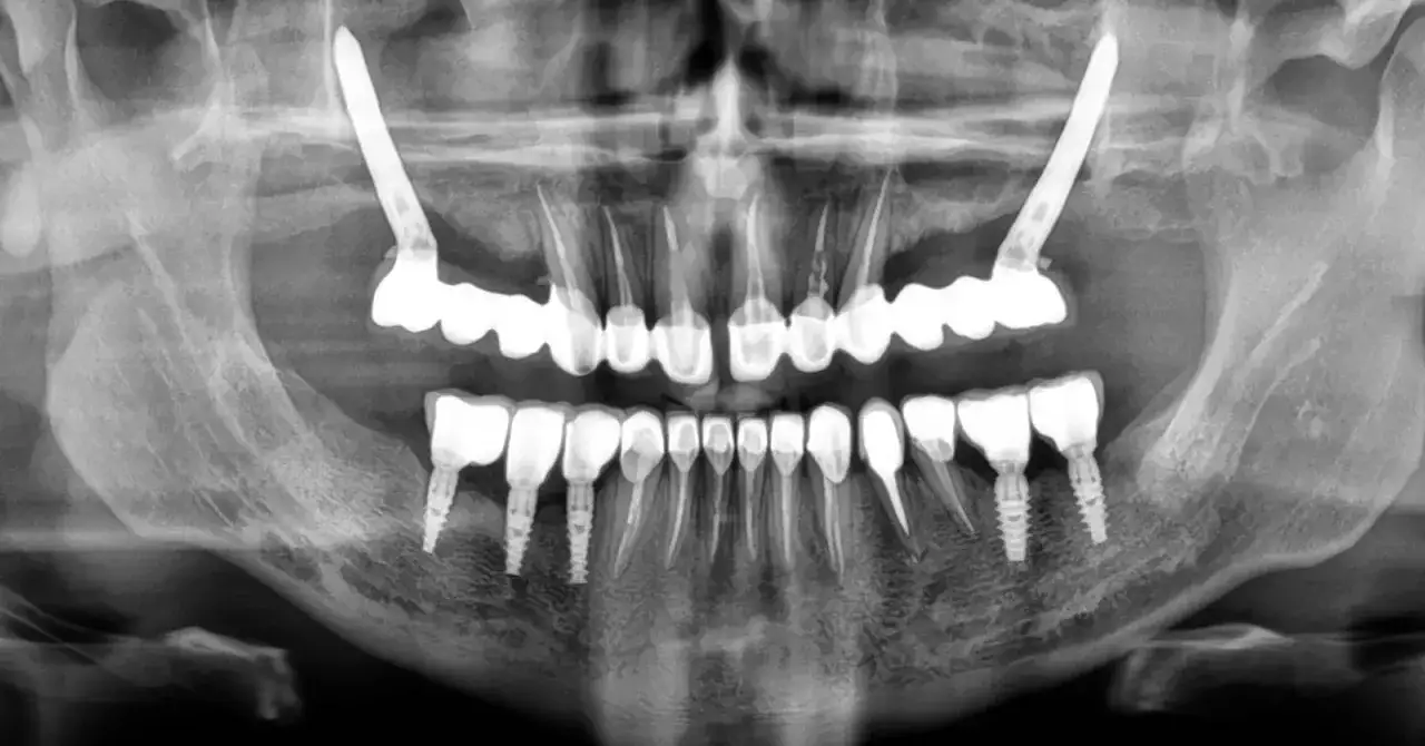 RTG szczęki z widocznymi implantami zygomatycznymi, które stabilizują uzębienie.