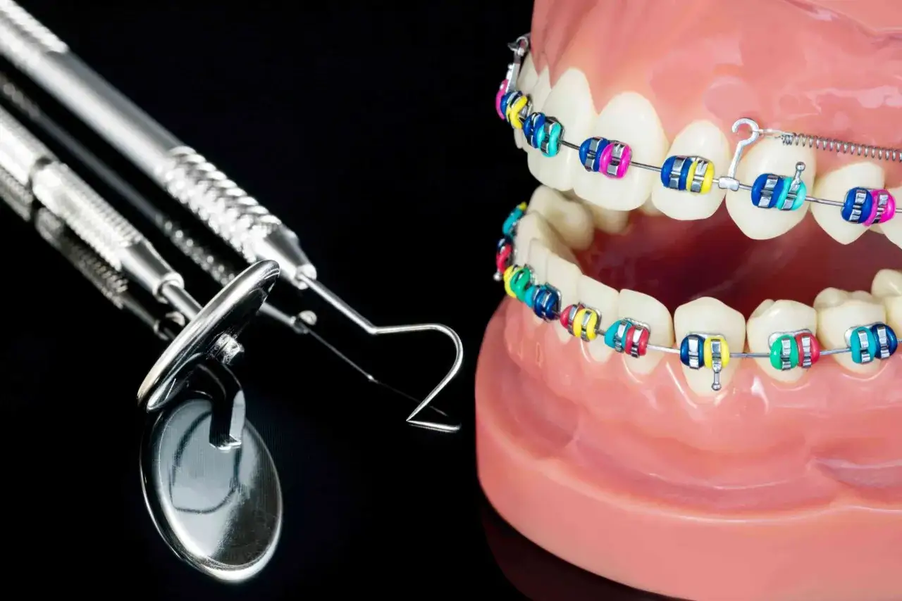 Kolorowe zamki na zębach modelu szczęki, które korygują zgryz krzyżowy, obok narzędzi dentystycznych.