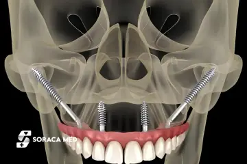 Model szczęki z implantami zygomatycznymi, pokazujący mocowanie protezy na implantach.