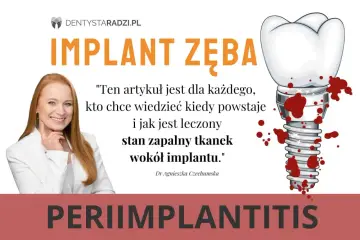 Stan zapalny tkanek wokół implantu, czyli periimplantitis, może prowadzić do ropnia. Grafika przedstawia implant zęba z krwawiącymi ranami.