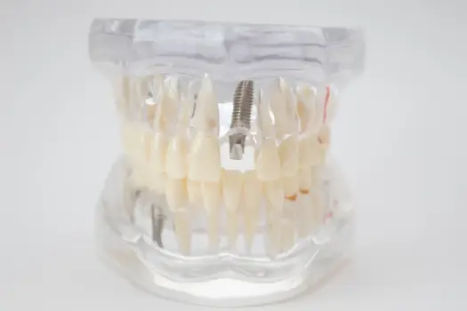 Niepokojące objawy po wszczepieniu implantu zęba - kiedy reagować?