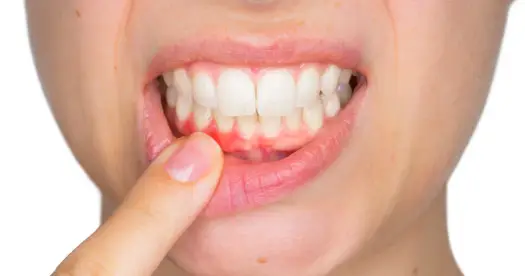 Poparzone dziąsła - co zrobić i kiedy iść do dentysty