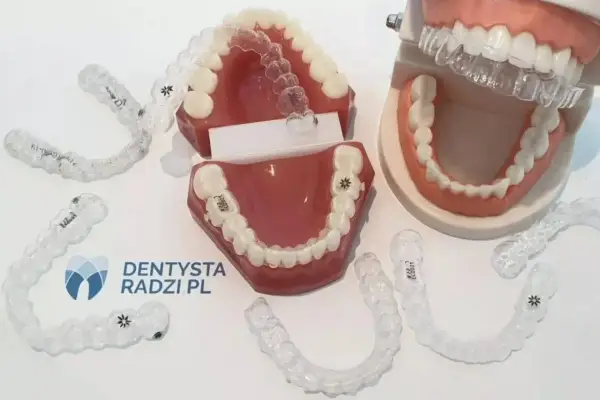 Aparat na zęby po dwóch miesiącach - co naprawdę widać?