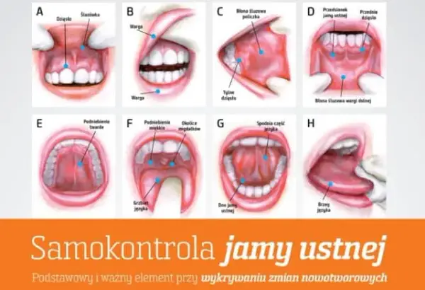 Jak wygląda rak jamy ustnej - objawy, które mogą zaniepokoić