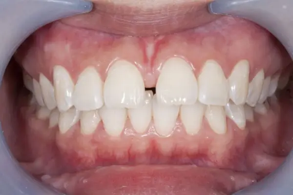 Diastema między zębami - kiedy to norma, a kiedy problem?