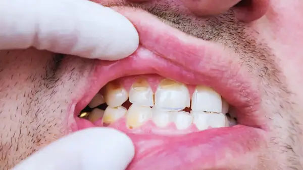 Ukruszony ząb - co zrobić od razu i kiedy do dentysty?