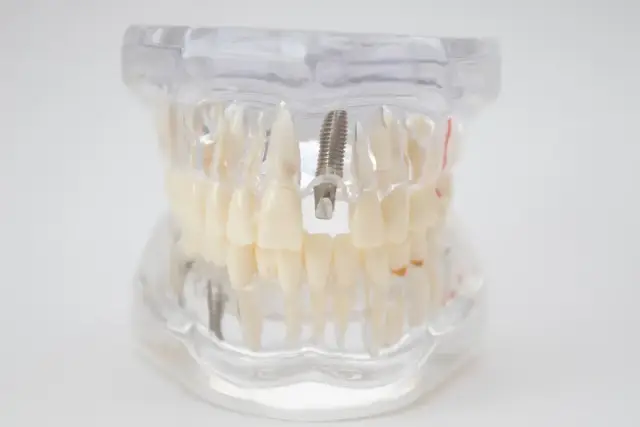 Model szczęki z implantem zębowym. Wszczepiony implant może powodować niepokojące objawy, jeśli nie jest prawidłowo osadzony.