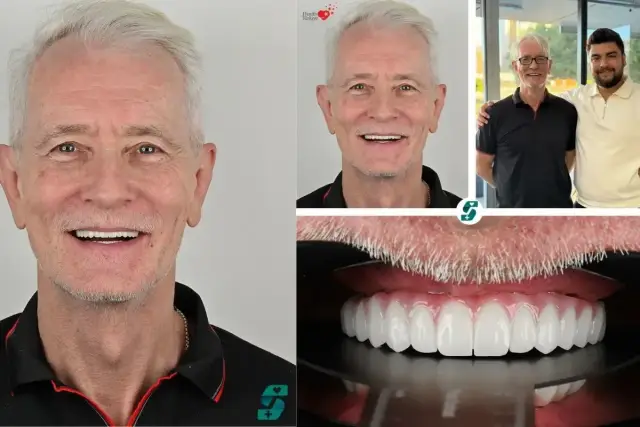 Uśmiechnięty mężczyzna przed i po zabiegu implantacji zębów. Nowe, białe zęby wyglądają naturalnie.