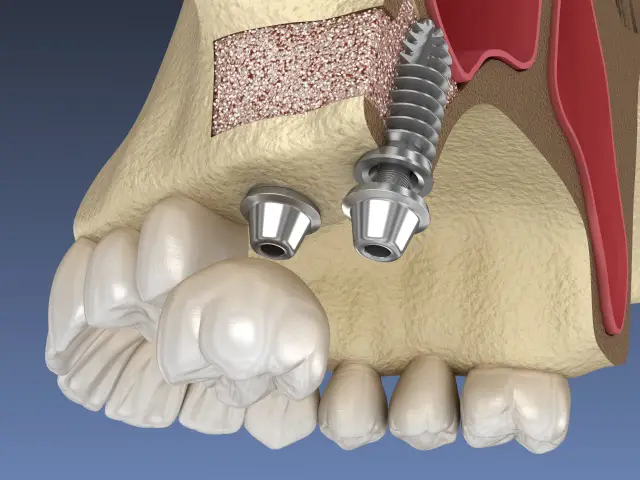 Model szczęki z implantami i materiałem kostnym. Widoczny podniesienie dna zatoki szczękowej, przygotowanie do wszczepienia implantu.