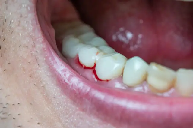 Krwawiące dziąsła, objaw zapalenia dziąseł (gingivitis), widoczne wokół zębów.