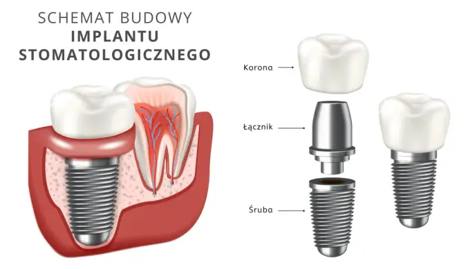 Implant zębowy krok po kroku. Zabieg, gojenie i koszt