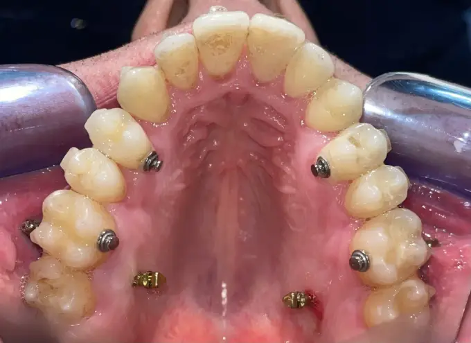 Miniimplant ortodontyczny - kiedy pomaga i ile kosztuje?