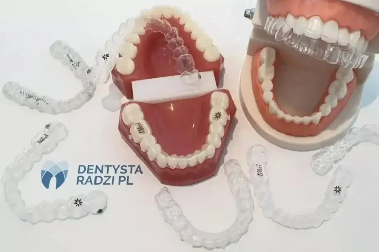 Aparat na zęby po dwóch miesiącach - co naprawdę widać?