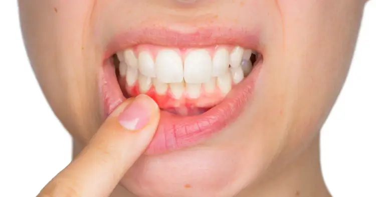 Poparzone dziąsła - co zrobić i kiedy iść do dentysty